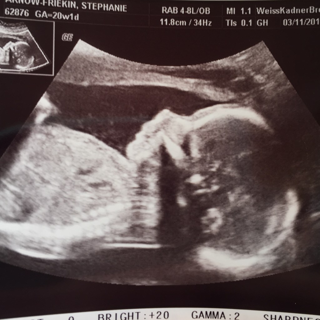 Arnow Baby#2 Ultra Sound